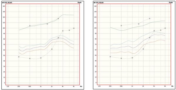 Sample patient with downward sloping hearing loss