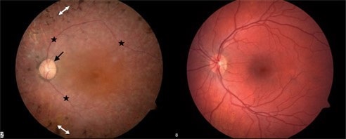 Comparison of healthy retina and retina affected by Usher syndrome