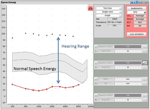 Example of Speechmap for a patient with a normal hearing range