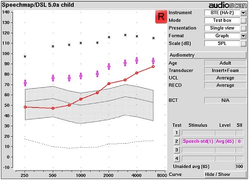 Speechmap of DSL 5.0 Child targets for an adult aged patient