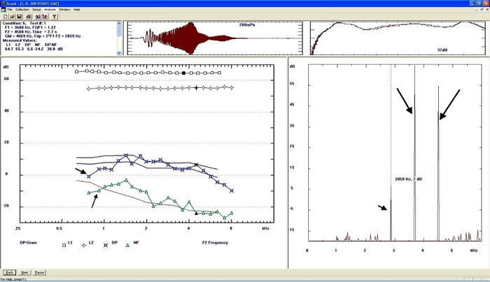 Analysis of DPAOEs