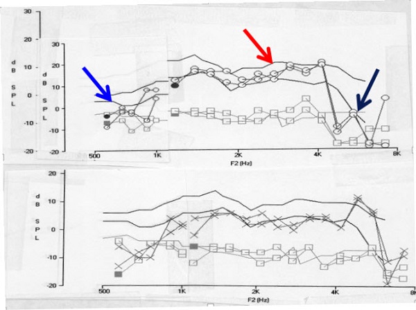 Acoustic Immittance in children without otoacoustic emissions