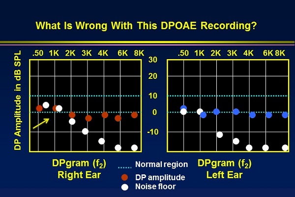 Inaccurate DPOAE recording