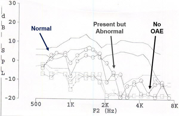 DPOAEs with poor high-frequency replication low-frequency absence and dip at 1000 Hz