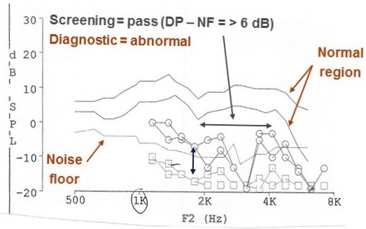 Abnormal screening DPOAEs