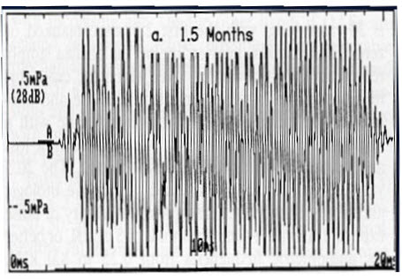 OAE from an infant