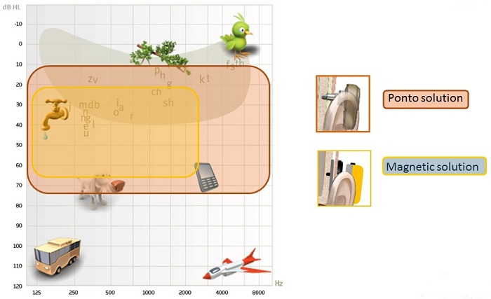 Patient schematic showing the range of audibility for the Ponto solution and a skin drive magnetic solution