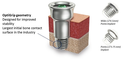 Ponto implant with OptiGrip Geometry