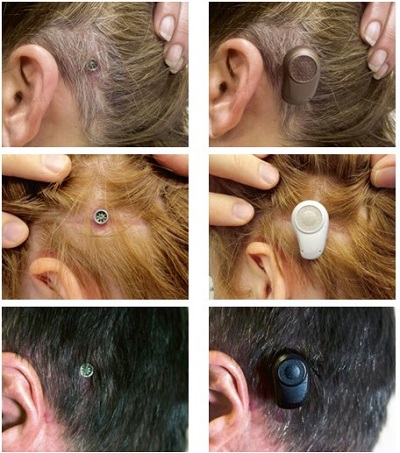 DIY Safety Line for Ponto or Baha Hearing Aid - The Baha Mama