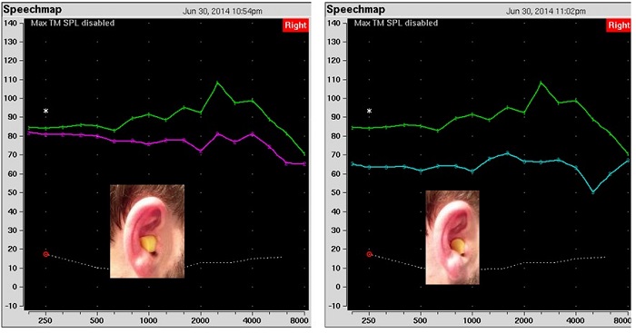 Real-ear measurements of a shallowly placed ear plug versus a deeply placed ear plug