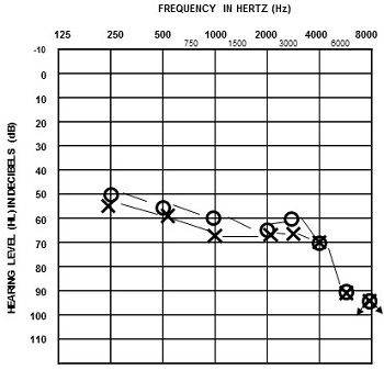 Audiogram of opera singer with hearing loss