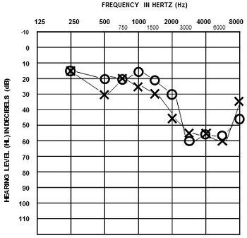 Audiogram of trial attorney who is an avid music fan and musician with hearing loss