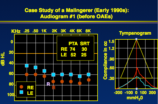Audiogram and tympanogram of a patient suspected of false hearing loss
