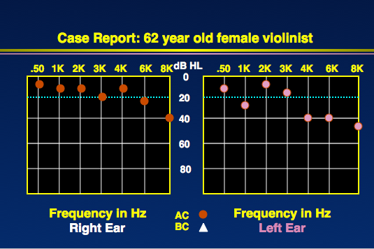 Audiogram from 62-year-old musician
