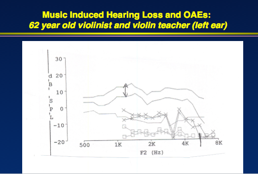 OAEs in left ear from 62-year-old violinist, indicating cochlear dysfunction that did not manifest on the audiogram