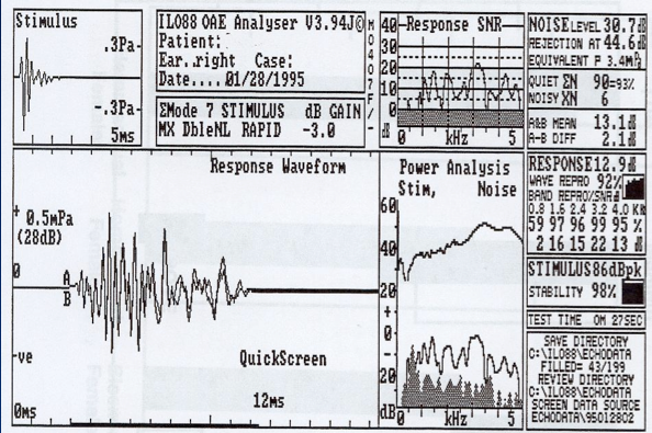 TEOAE response screen from the Otodynamics ILO88 system