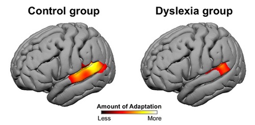 fMRI images show how people with dyslexia and people without adapt differently to a speaker’s voice