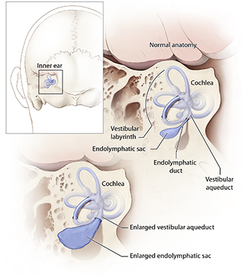 Mutations in SLC26A4 cause a hereditary hearing loss disorder characterized by enlargement of a structure in the inner ear