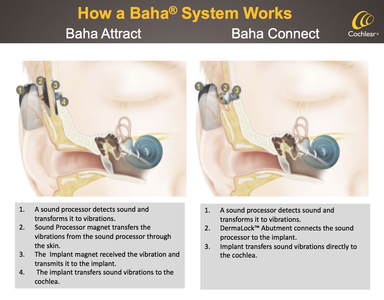 How a Baha System works