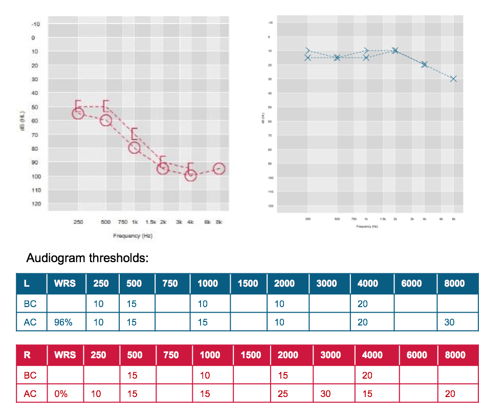 Lia's audiogram thresholds