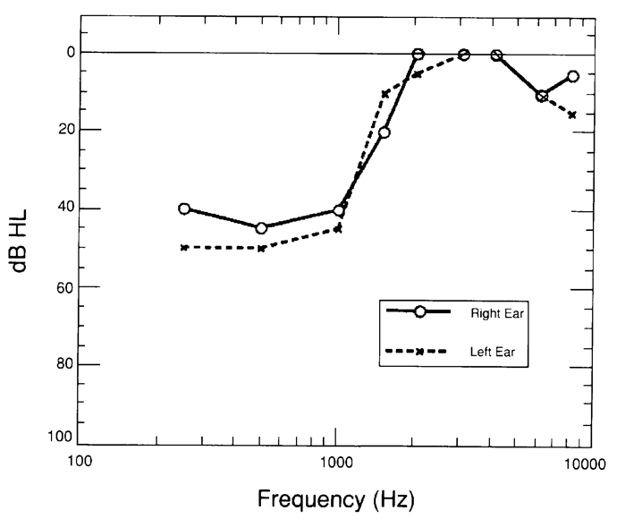 Audiogram