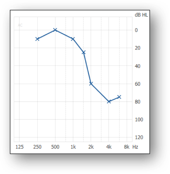 Three types of audiograms that can challenge how to approach a fitting