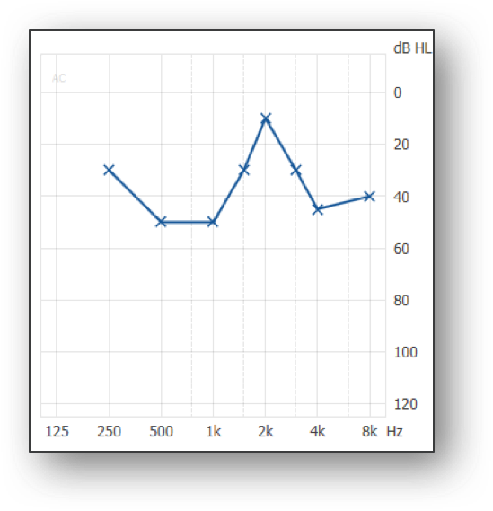 Three types of audiograms that can challenge how to approach a fitting