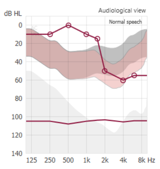 Modest audibility enhancement for a ski-slope loss patient