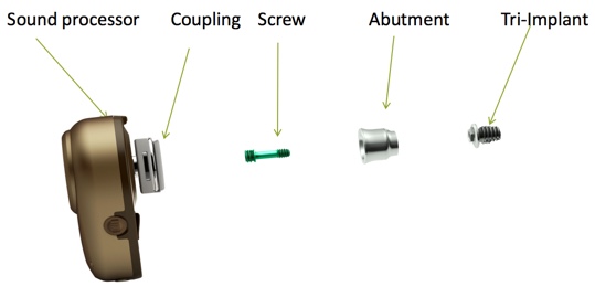Components of BAHS devices and implant