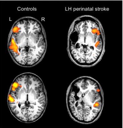  individual scans of two healthy controls and two individuals with a left-hemisphere perinatal stroke