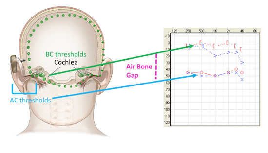 Audiogram of conductive hearing loss