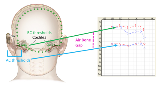 conductive hearing loss diagram