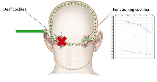 Audiogram of unilateral sensorineural hearing loss