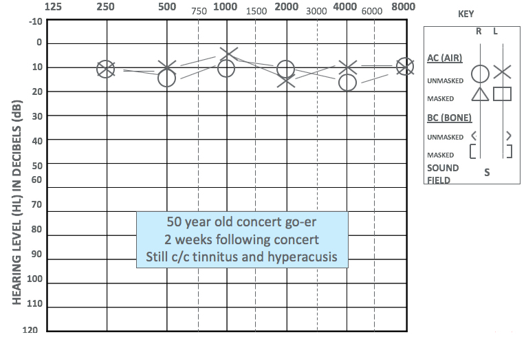 Acoustic Trauma From Recreational Noise Exposures Brian J Fligor Hearing And Hearing Loss Hearing Conservation And Nihl 23542