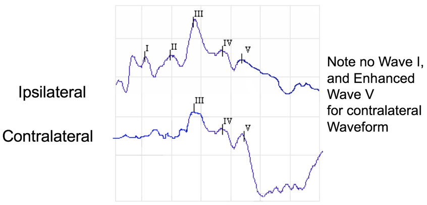 Ipsilateral versus contralateral waveforms