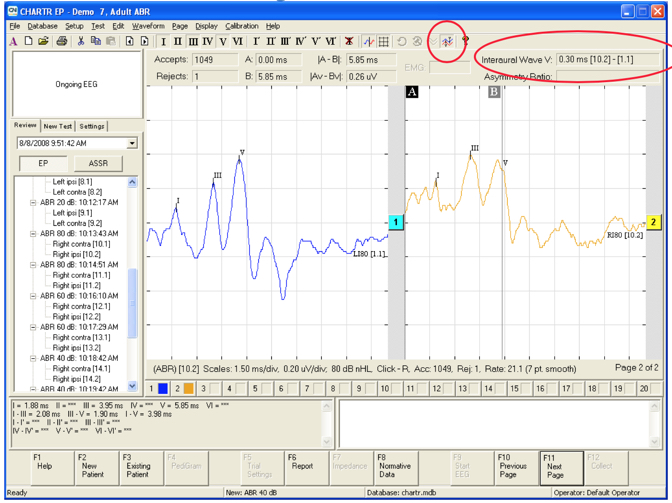 Screenshot of how to measure interwave latency intervals