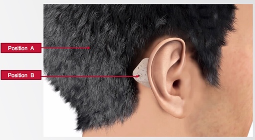 Optimal position behind the ear