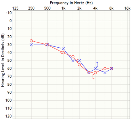 Mr. F’s audiogram