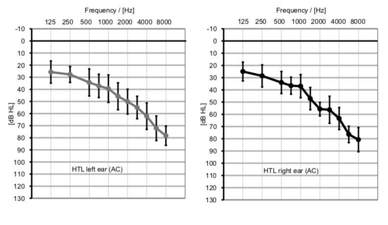 Average pure tone audiograms of the participants for the left ear and the right ear