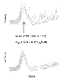 vHIT traces from an individual with normal vestibular function