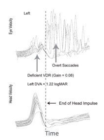 vHIT traces from an individual with abnormal vestibular function