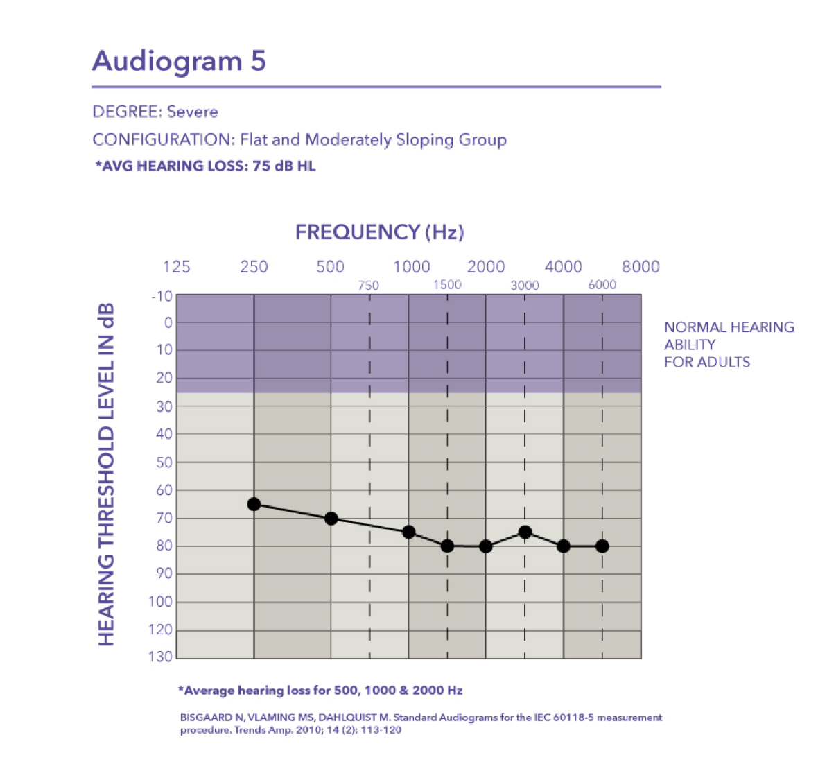 Severe range with a pure tone average of 75 dB HL