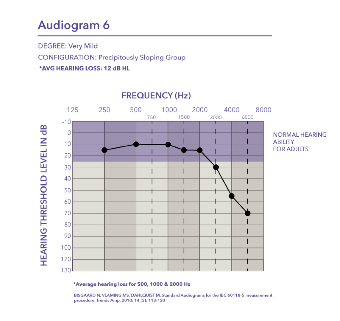 Very mild hearing loss with a pure tone average of 12 dB