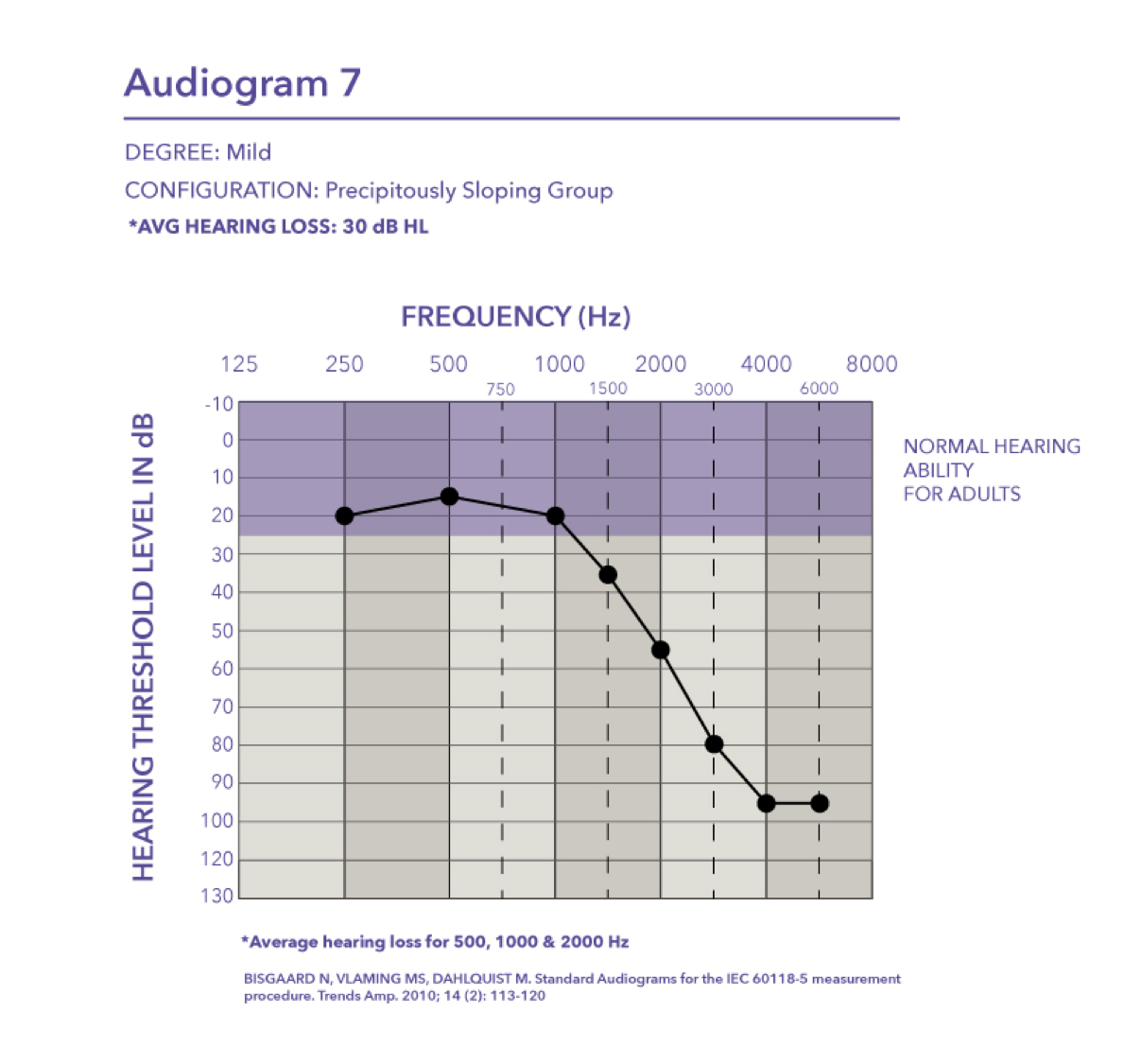 Mild hearing loss with a pure tone average of 30 dB HL