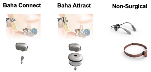 The 3 baha systems (baha connect baha attract and non-surgical)
