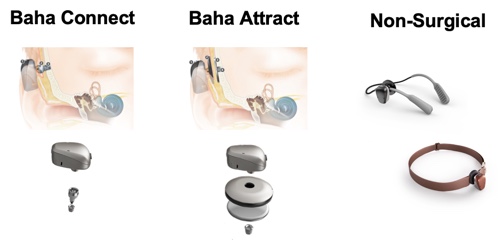 Why You Should Treat Bilateral Hearing Loss with Two Hearing Aids -  Audiology Services Inc