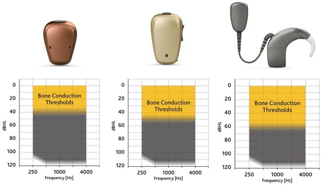 Baha 5 sound processors