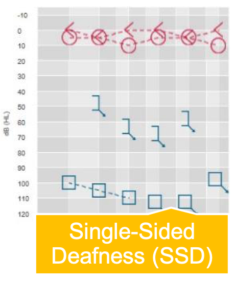 Audiogram of someone with SSD