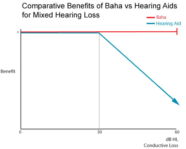 Benefits of Baha versus hearing aids for mixed hearing loss