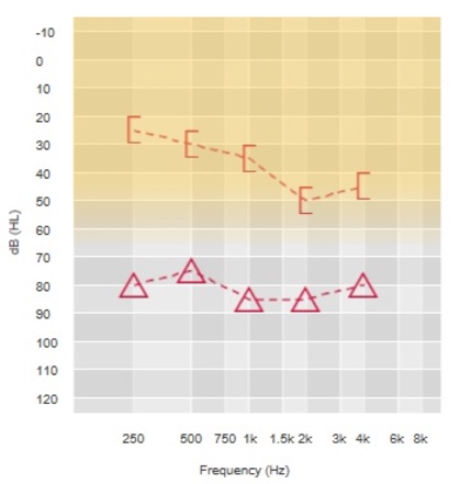 Bone conduction thresholds for determining Baha candidacy